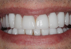 Prestige Dentistry | ZOOM  Whitening, Candid trade  Clear Aligners and Inlays  amp  Onlays