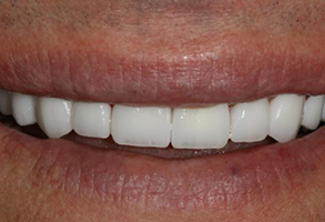 Prestige Dentistry | ZOOM  Whitening, All-on-6 reg  and Implant Restorations