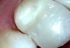 Prestige Dentistry | Crowns, ClearCorrect reg  and Ceramic Crowns