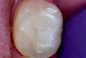 Prestige Dentistry | Digital Impressions, Full Mouth Reconstruction and Oral Cancer Screening