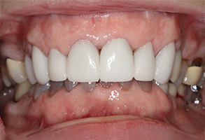 Prestige Dentistry | Dental Sealants, Preventative Program and ClearCorrect reg 