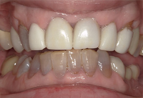 Prestige Dentistry | Root Canals, Crowns and All-on-4 reg 