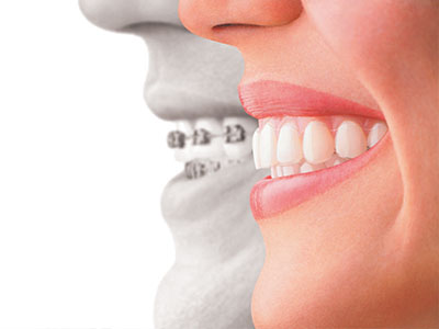 The image shows a split-screen comparison between two individuals, with one half displaying a person s natural teeth and facial features, and the other half showing a dental implant, emphasizing the difference in appearance before and after dental implant treatment.