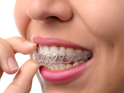 The image shows a person with clear braces, holding their teeth up to inspect them closely.
