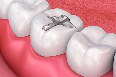 The image displays a close-up view of a set of teeth with a prominent silver ring placed between two front teeth, set against a pink background that suggests a mouth interior, possibly for dental illustration purposes.