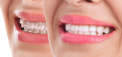 The image shows two close-up views of a person s smiling face with teeth, featuring pink lipstick and a partial view of their nose and chin.