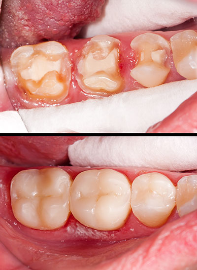 The image shows a close-up view of a person s mouth with multiple teeth missing and rotting, revealing yellowed stumps and some remaining teeth with visible cavities and discoloration.