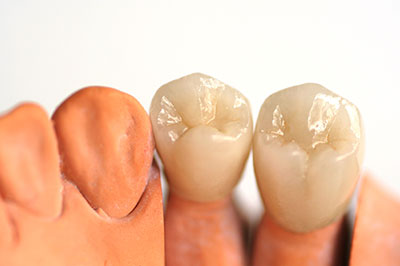 The image shows a close-up view of two artificial teeth, likely for dental implants, with an orange hue, placed side by side against a white background.