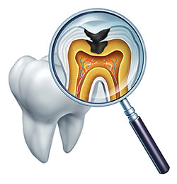 The image displays a magnified view of a tooth with an X-ray showing its internal structure, including the root and pulp chamber, with a focus on the cavity and tooth decay.