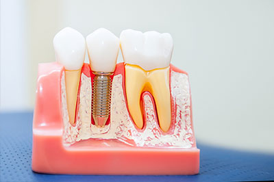 The image shows a close-up of a dental implant with a screw visible at the top, placed on a pink base that resembles a gumline.