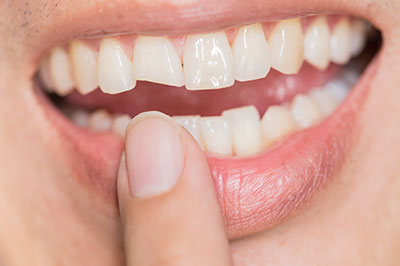 The image shows a person with an open mouth displaying their teeth, holding a finger up to their lips as if to emphasize something, with a close-up view of a noticeable dental issue, potentially a cavity or decay, on one of their front teeth.