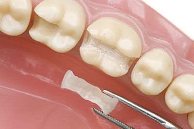 The image shows a close-up view of a dental implant with a small screw visible on its surface, placed within a tooth mold or wax impression, which appears to be part of a dentist s office setup.