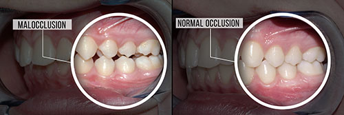 The image displays a split-screen comparison of a person s teeth before and after dental treatment, with text indicating  Malocclusion  in one frame and pointing at the teeth in the other.