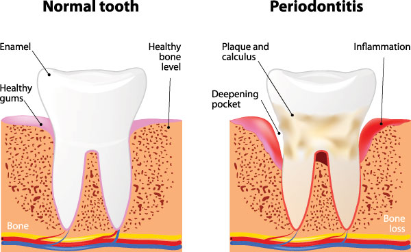 The image is a medical diagram showing two stages of dental decay progression, with the left side labeled  normal tooth  and the right side labeled  periodontitis,  highlighting the development of gum disease and cavities.