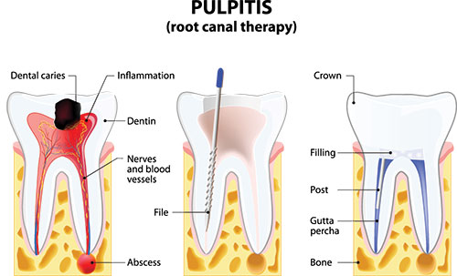 The image displays a step-by-step illustration of the process of dental implant surgery, showing various stages including preparation of the jawbone, placement of a titanium screw, and attachment of a dental implant post.