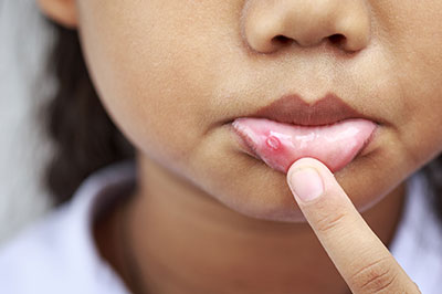 The image shows a close-up of a person s face with acne on their nose, finger pointing at the skin blemish, and lips pursed as if they are making a statement or expression.