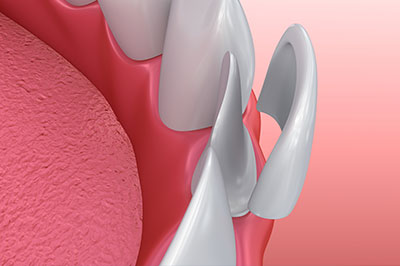 The image shows a close-up of a dental implant with a pink gum background, featuring a metallic screw-like structure and a smooth surface, possibly for an accessibility purpose to describe the content of the image.