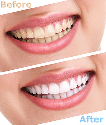 The image shows a before-and-after comparison of dental whitening treatments, featuring a woman with a bright smile after teeth whitening.