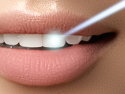The image displays two close-ups of a person s mouth with a focus on their teeth, showcasing a bright smile.